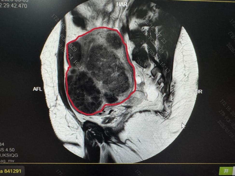 PUSH术前患者MRI子宫图像(红色线内区域为子宫)及子宫内弥漫存在的肌瘤影