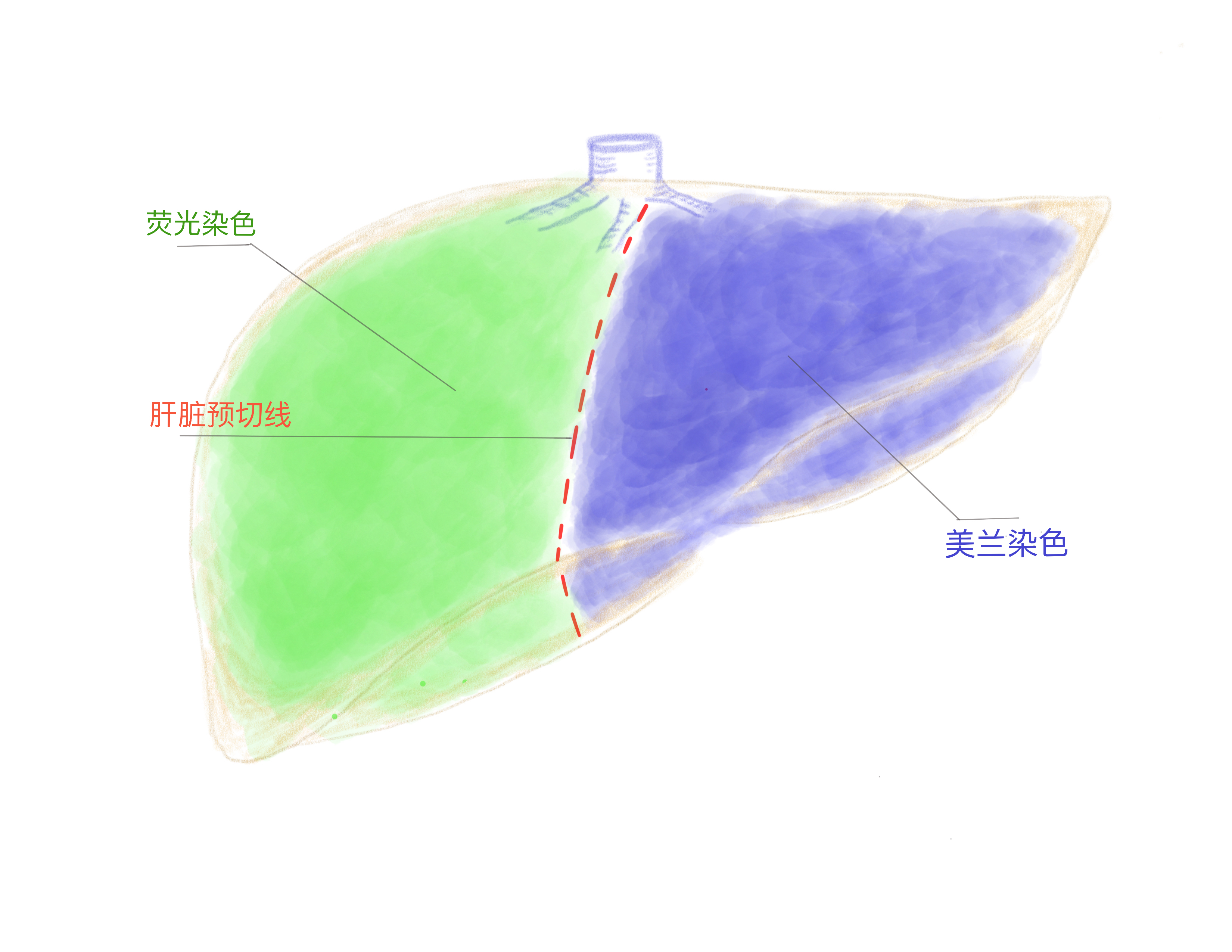 △术中美兰荧光双染色示意图