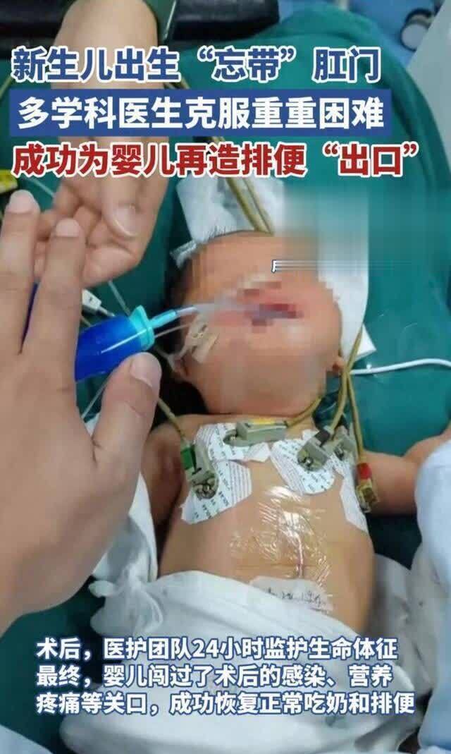 宝宝出身竟无肛门！多学科大夫联手攻坚，告捷再造排便通谈