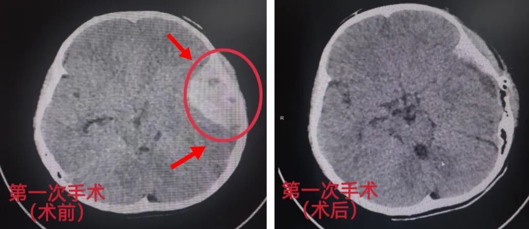 颞顶部CT图