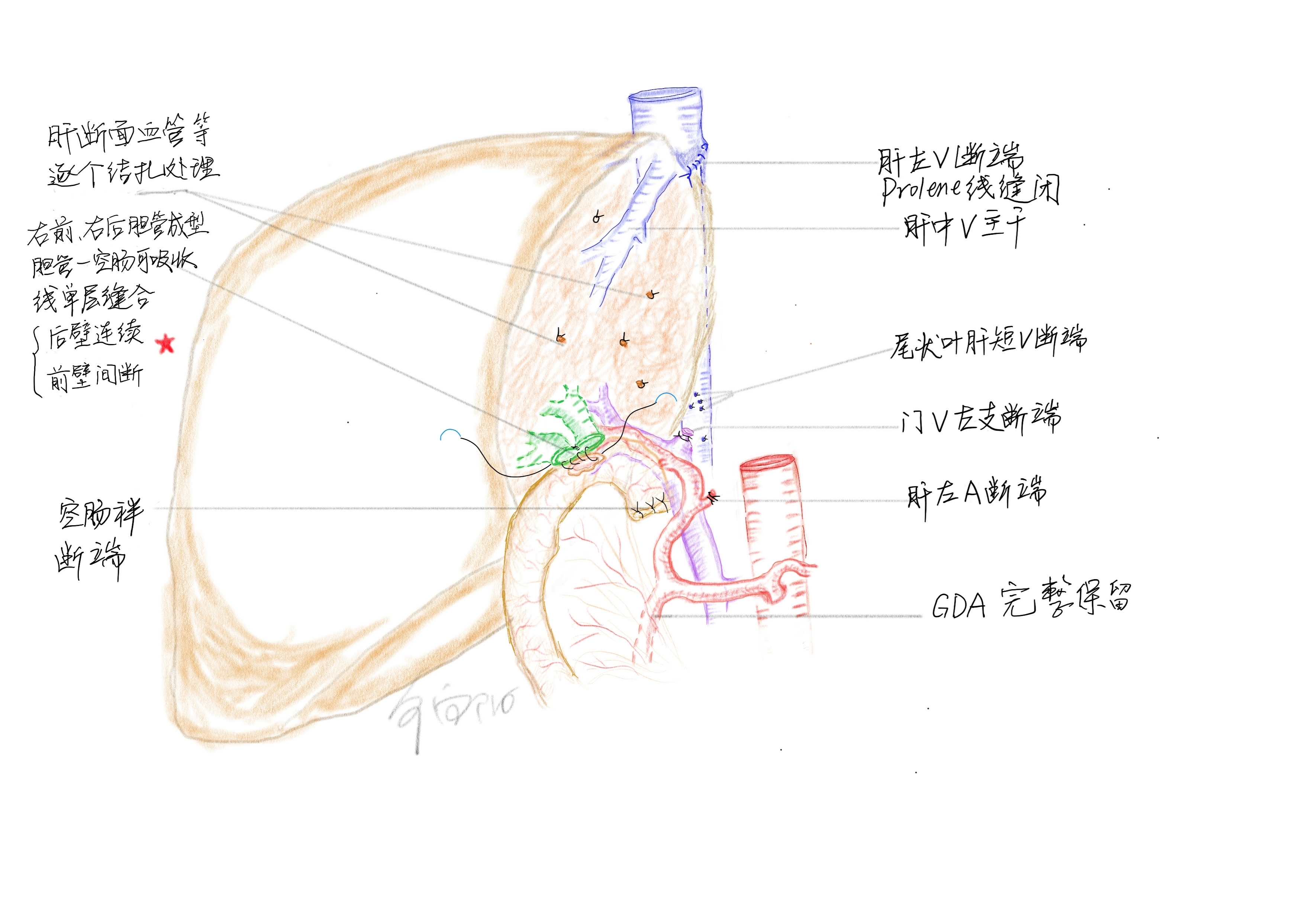 △步向阳术后绘制手术记录附图（部分）