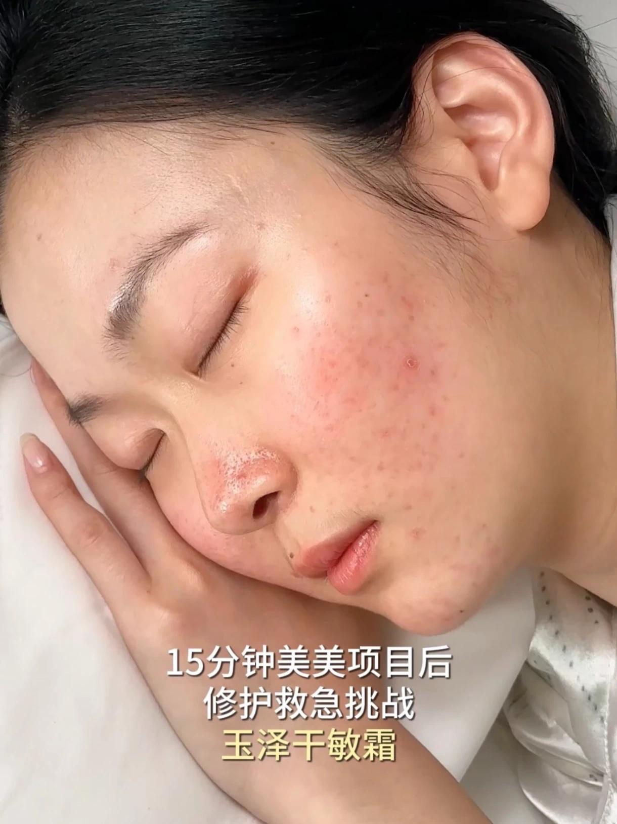 美美项目后舒缓急救，选玉泽修护面霜，长效维稳保湿