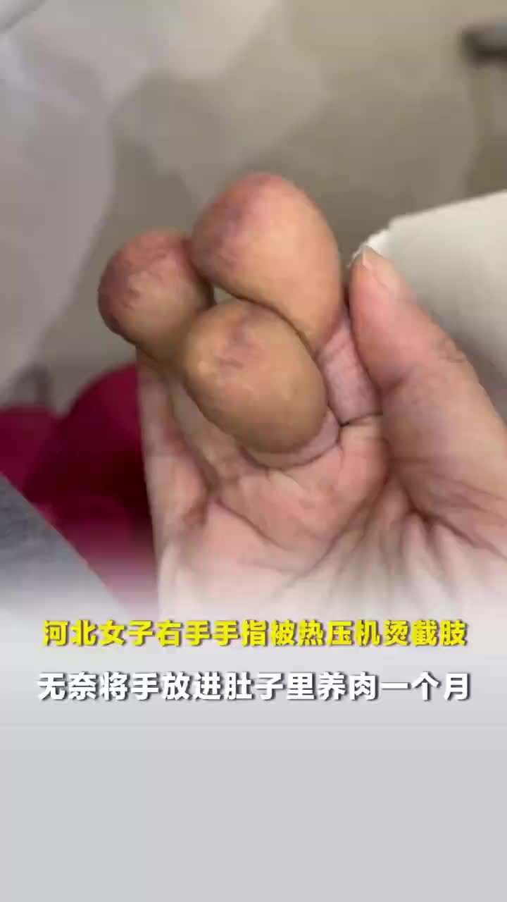 女子手指截肢放肚子里养肉修复