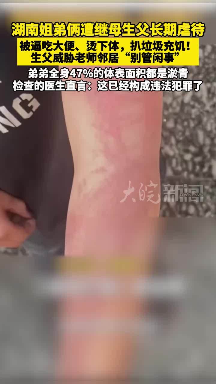 湖南姐弟俩遭继母生父长期虐待，被逼吃大便、烫下体，扒垃圾充饥！生父威胁老师邻居“别管闲事”弟弟全身47%的体表面积都是淤青，检查的医生直言：这已经构成违法犯罪了