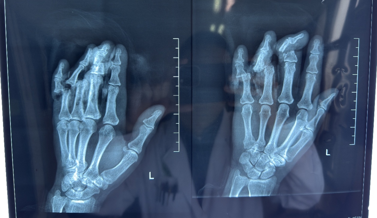 突发！女子被压断3根手指，中大医院专家紧急手术接活断指