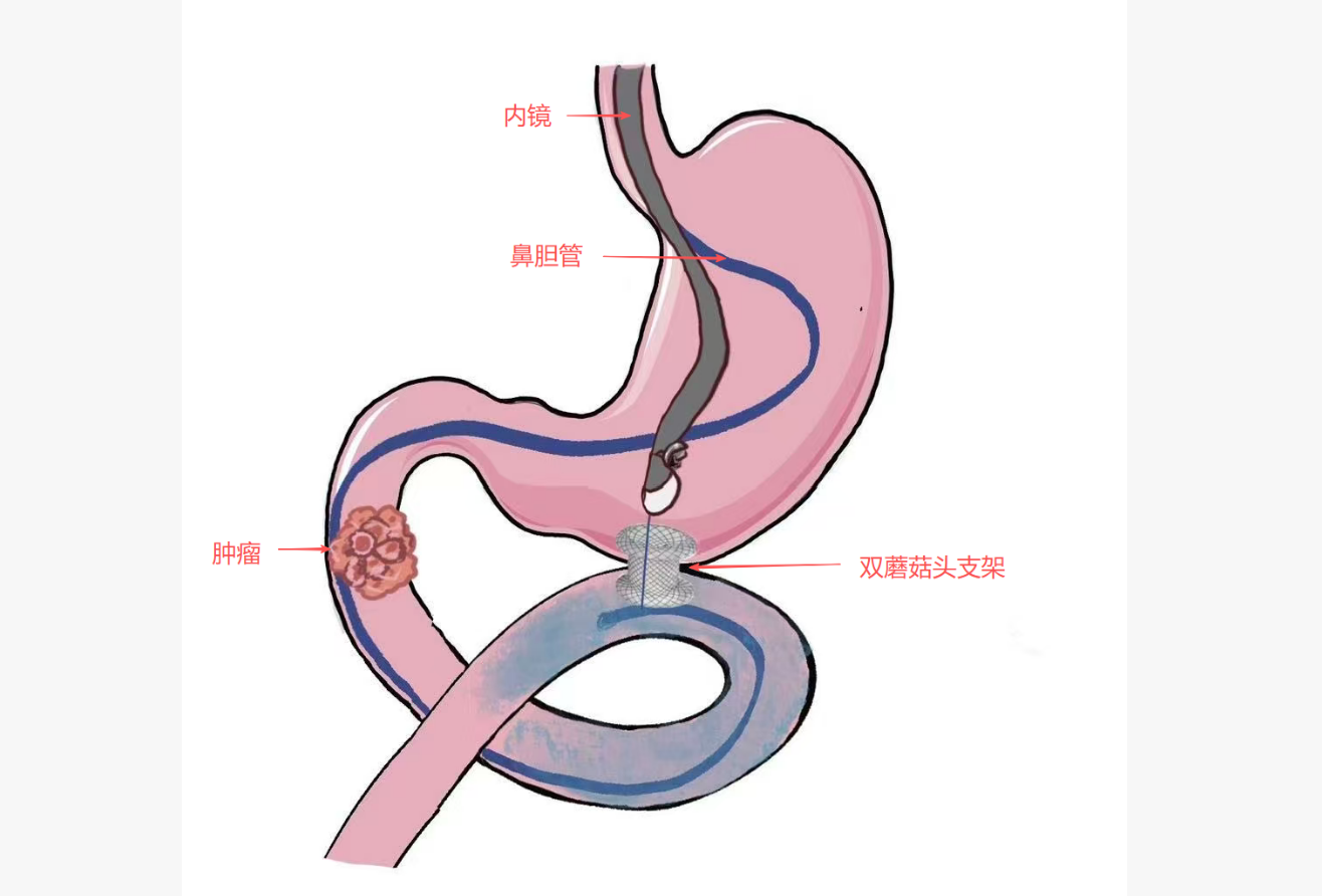 81岁老人“滴水不进”，医生在他肚子里搭了座“高架桥”