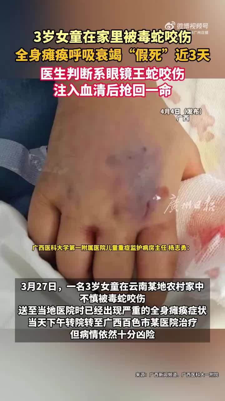 3岁女童被毒蛇咬伤假死3天奇迹生还