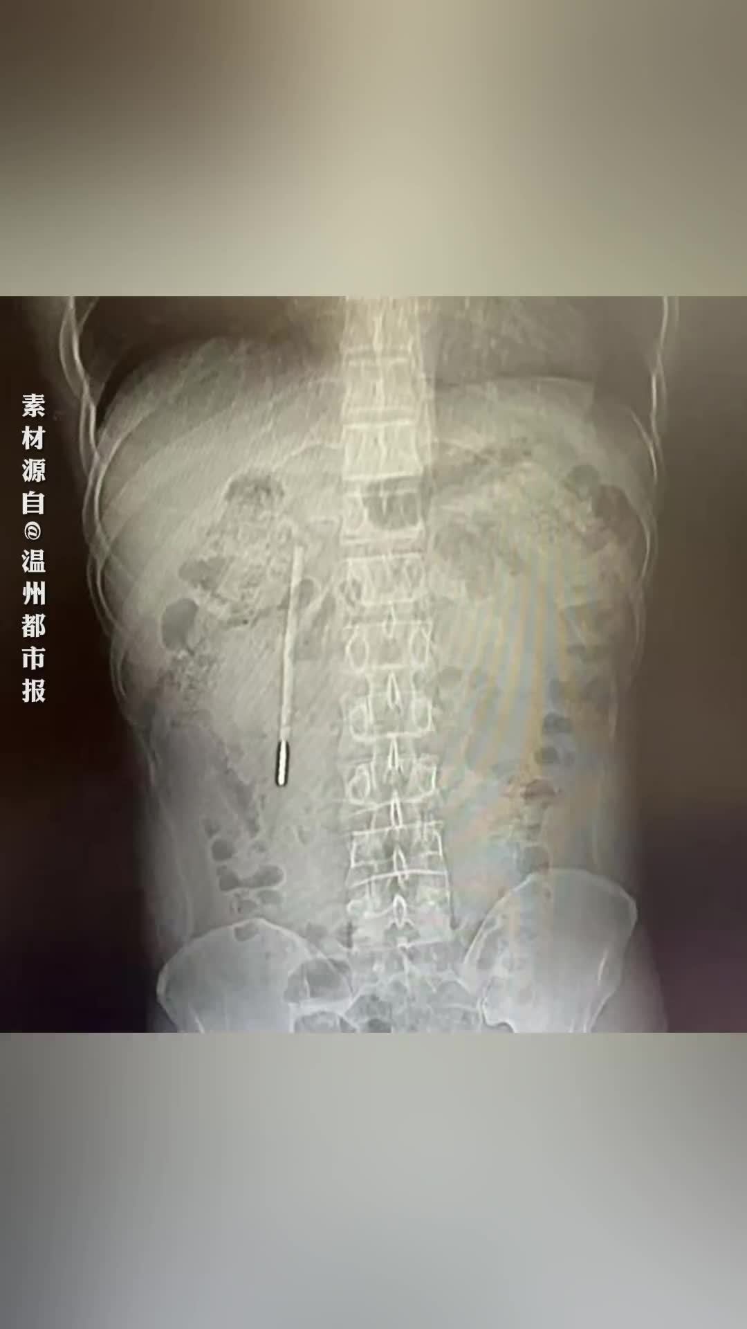 32岁男子腹痛就医，取出20年前吞下的体温计，当事人：12岁时误吞