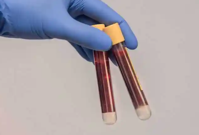 体查抄出低密度脂卵白高,怎么办?医陌生远:尽量少碰这4种食品