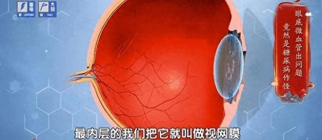 血管要出事,眼睛先报警,出现这种信号,再拖等于脑梗、失明了