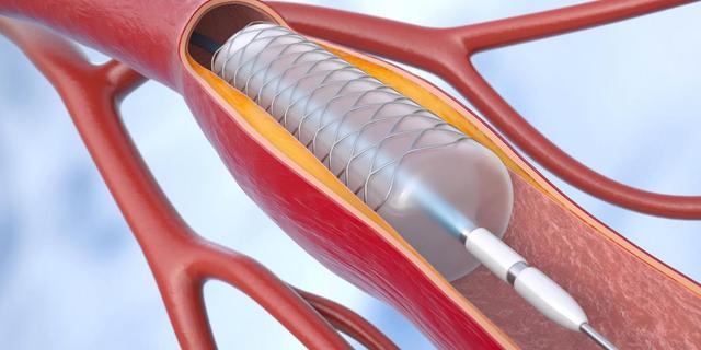 腹黑支架9大谎话！忽悠了几许东说念主！此次腹黑大夫辟谣一次评释晰