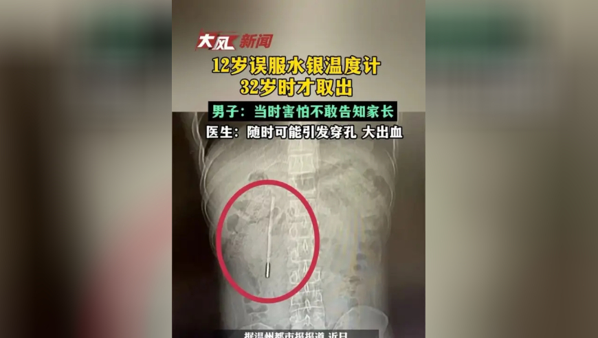 12岁误服水银温度计32岁时才取出，男子：当时因害怕不敢告知家长