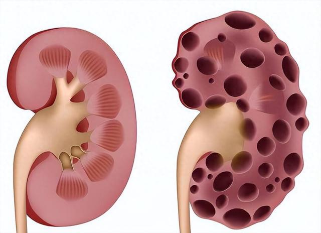 有1个被渐忘的中成药,是肾囊肿的克星,很少有东谈主宠爱它