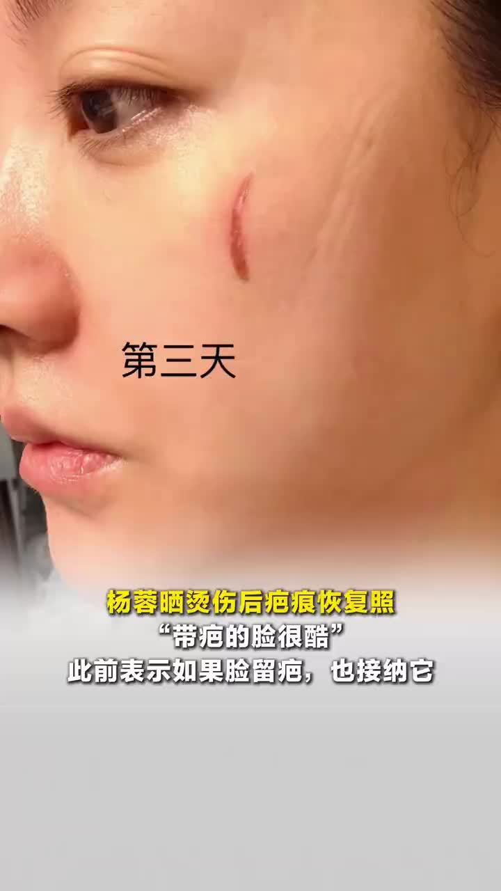 杨蓉晒烫伤后疤痕恢复照，杨蓉称带疤的脸很酷