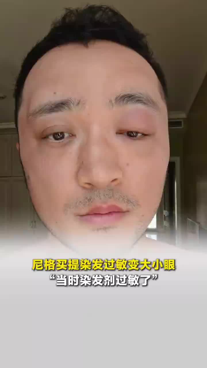 尼格买提染发过敏变大小眼，“别染发，当时染发剂过敏了”