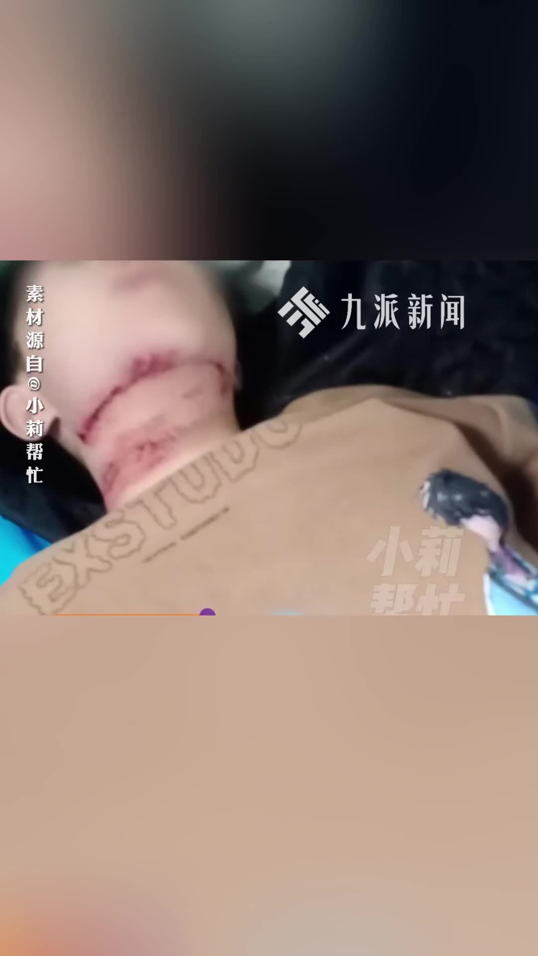 遭绳子锁喉的13岁男孩已转诊北京，镇政府：治疗费依靠水滴筹