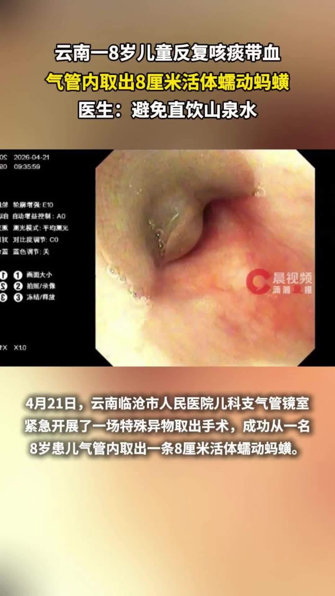 云南一8岁儿童反复咳痰带血，气管内取出8厘米活体蠕动蚂蟥，医生：避免直饮山泉水