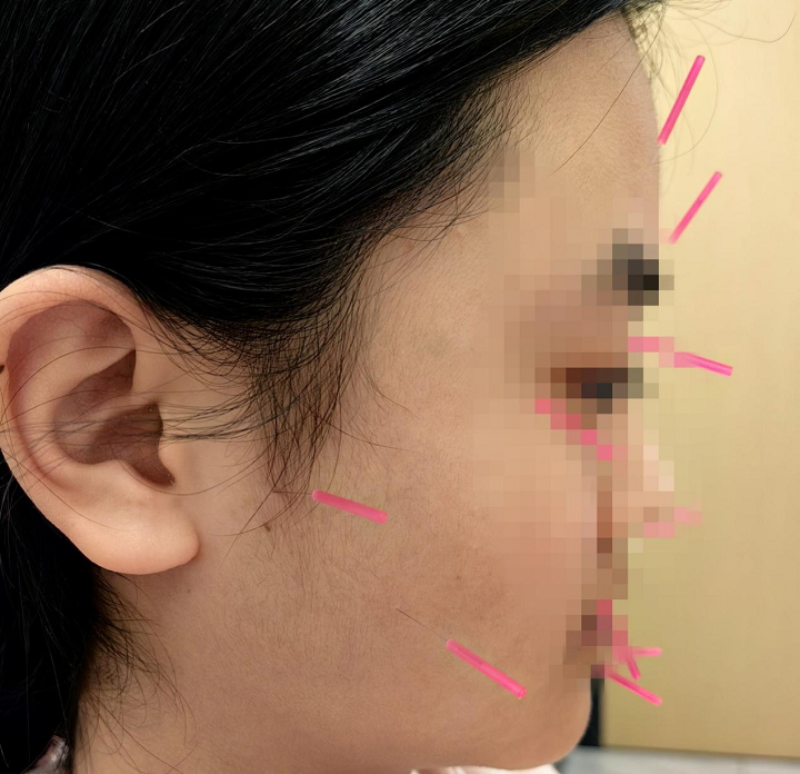 秦皇岛市中医医院儿科推儿童元气针：调理体质助孩子少生病