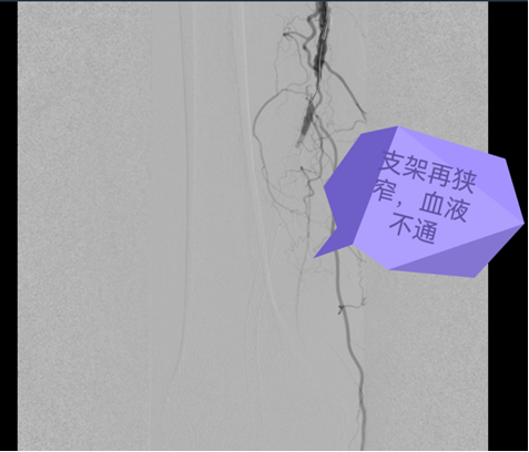 秦皇岛：支架叠支架非唯一出路，旋切术直接把斑块“刨”出体外