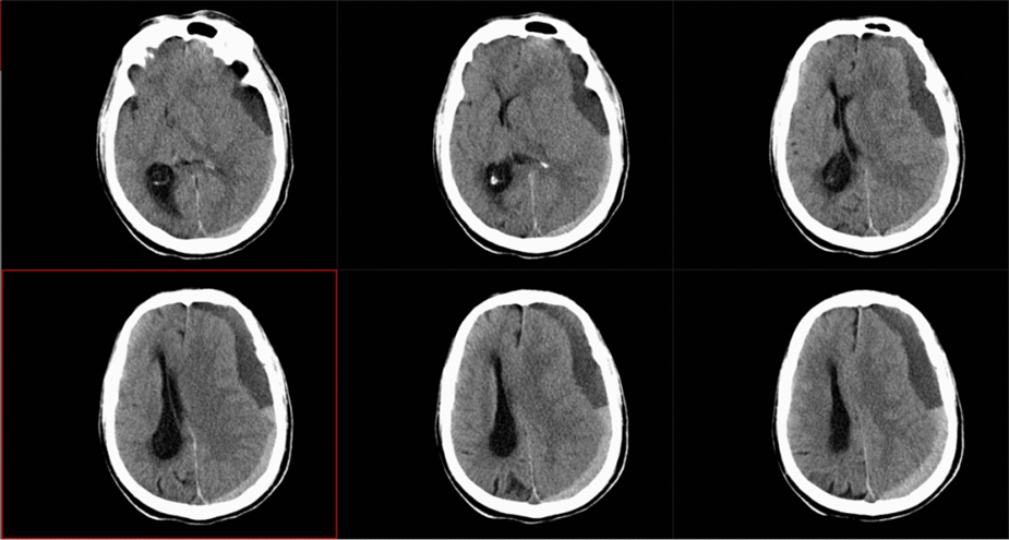 图1 急诊CT影像，见左侧硬膜下混杂慢性硬膜下血肿，中线受压右移。