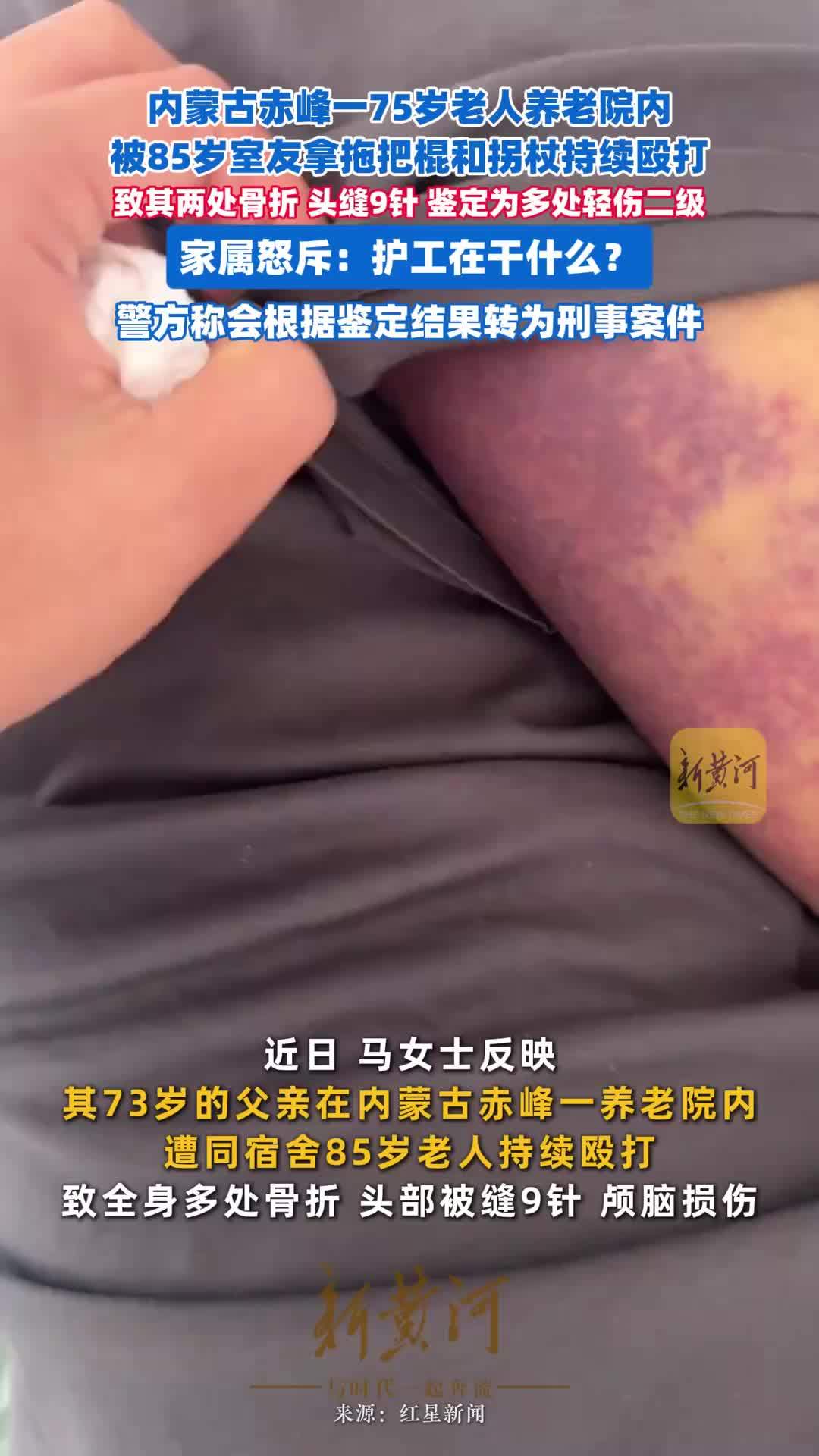 内蒙古赤峰一75岁老人养老院内被85岁室友拿拖把棍和拐杖持续殴打，致其两处骨折、头缝9针，鉴定为多处轻伤二级。家属怒斥：护工在干什么？警方已称会根据鉴定结果转为刑事案件