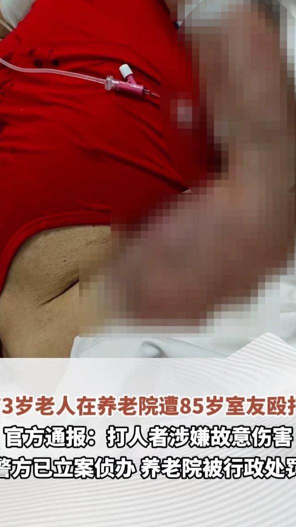 73岁老人在养老院遭85岁室友殴打，全身多处骨折、头部被缝9针，官方通报：打人者涉嫌故意伤害，警方已立案侦办，养老院被行政处罚