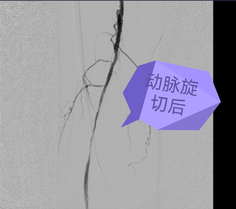 秦皇岛：支架叠支架非唯一出路，旋切术直接把斑块“刨”出体外