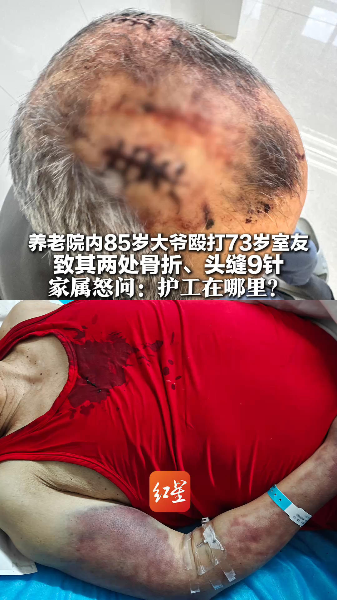 养老院内85岁大爷殴打73岁室友 致其两处骨折、头缝9针 家属怒问：护工在哪里？警方称会根据鉴定结果，转为刑事案件