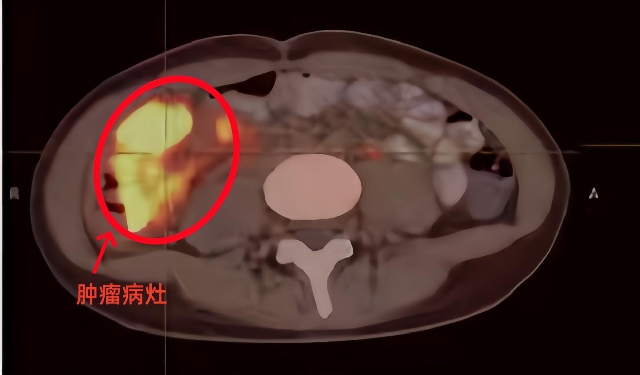 反复腹痛半年,14岁女孩确诊晚期肠癌 有这些早期信号需早防早筛