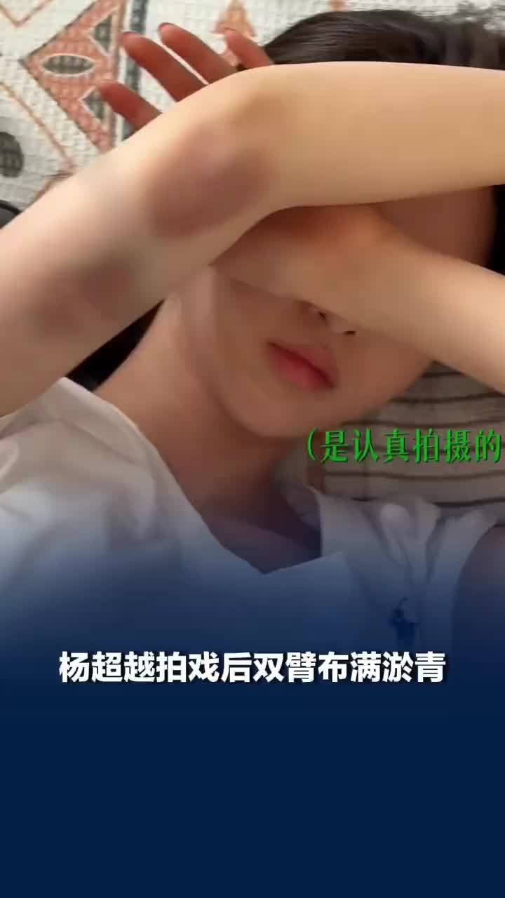 杨超越拍戏后双臂布满淤青
