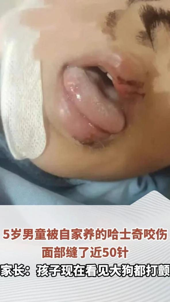 5岁男童被自家养的哈士奇咬伤，面部缝了近50针。家长：狗已被处理，“孩子现在看见大狗都打颤”