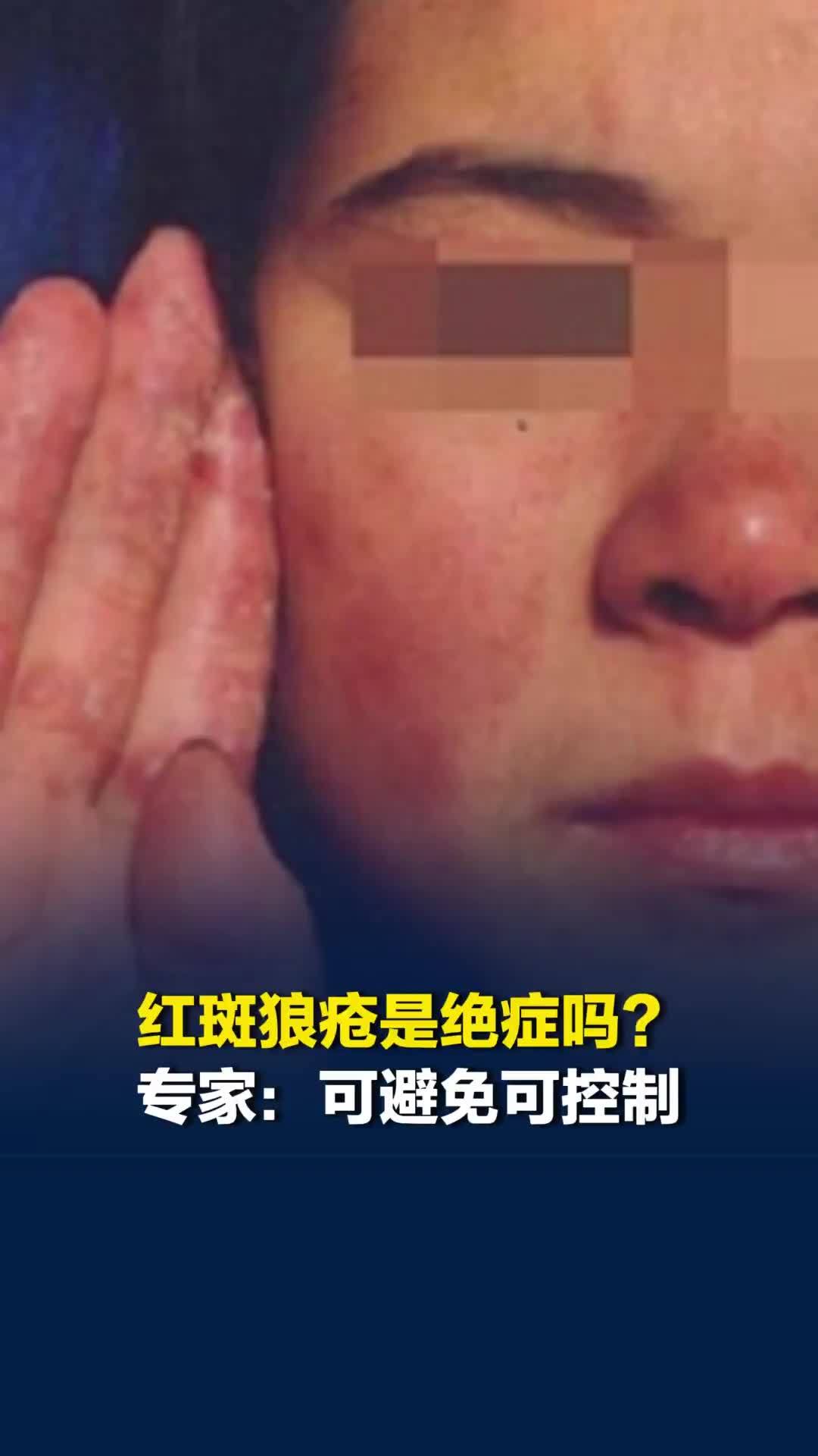 红斑狼疮是绝症吗？皮肤科专家：不要怕！虽不能根治，但可避免可控制