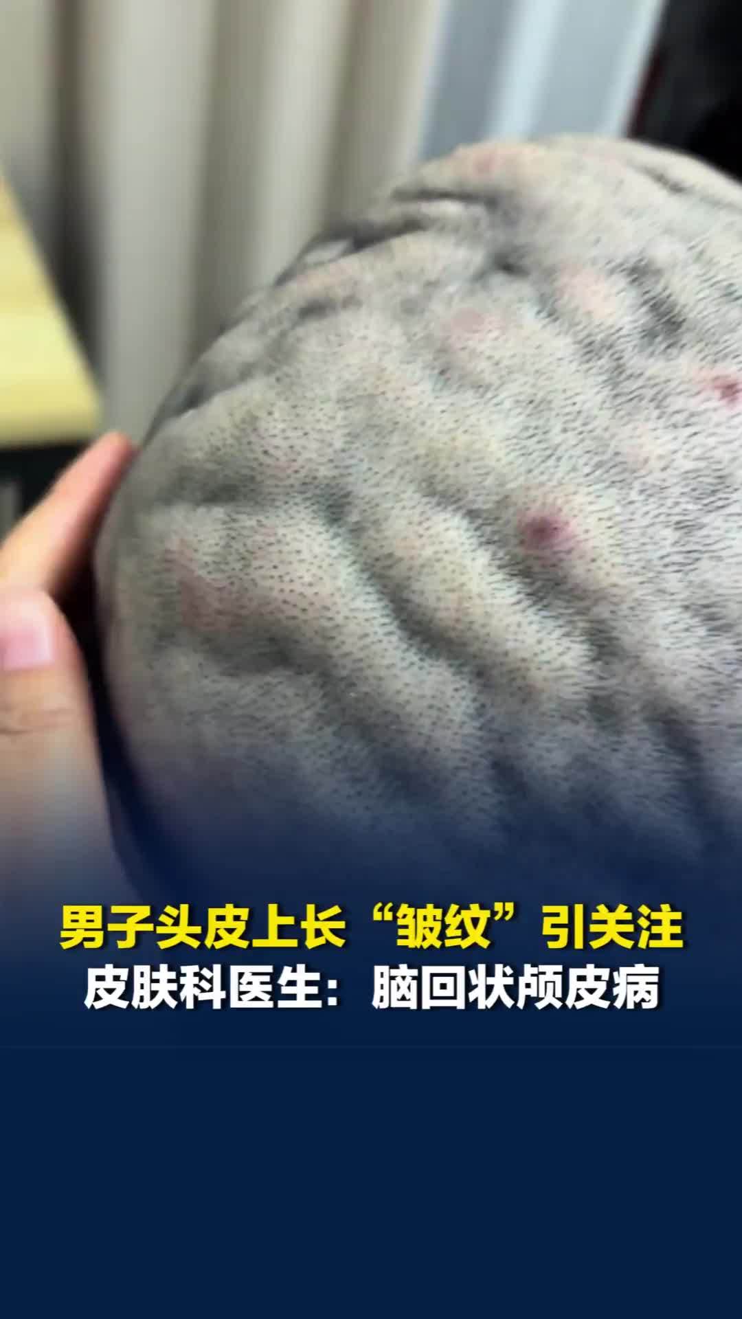 男子头皮上长“皱纹”引网友围观，医生：脑回状颅皮病，系头皮皮肤过度生长的畸形外观