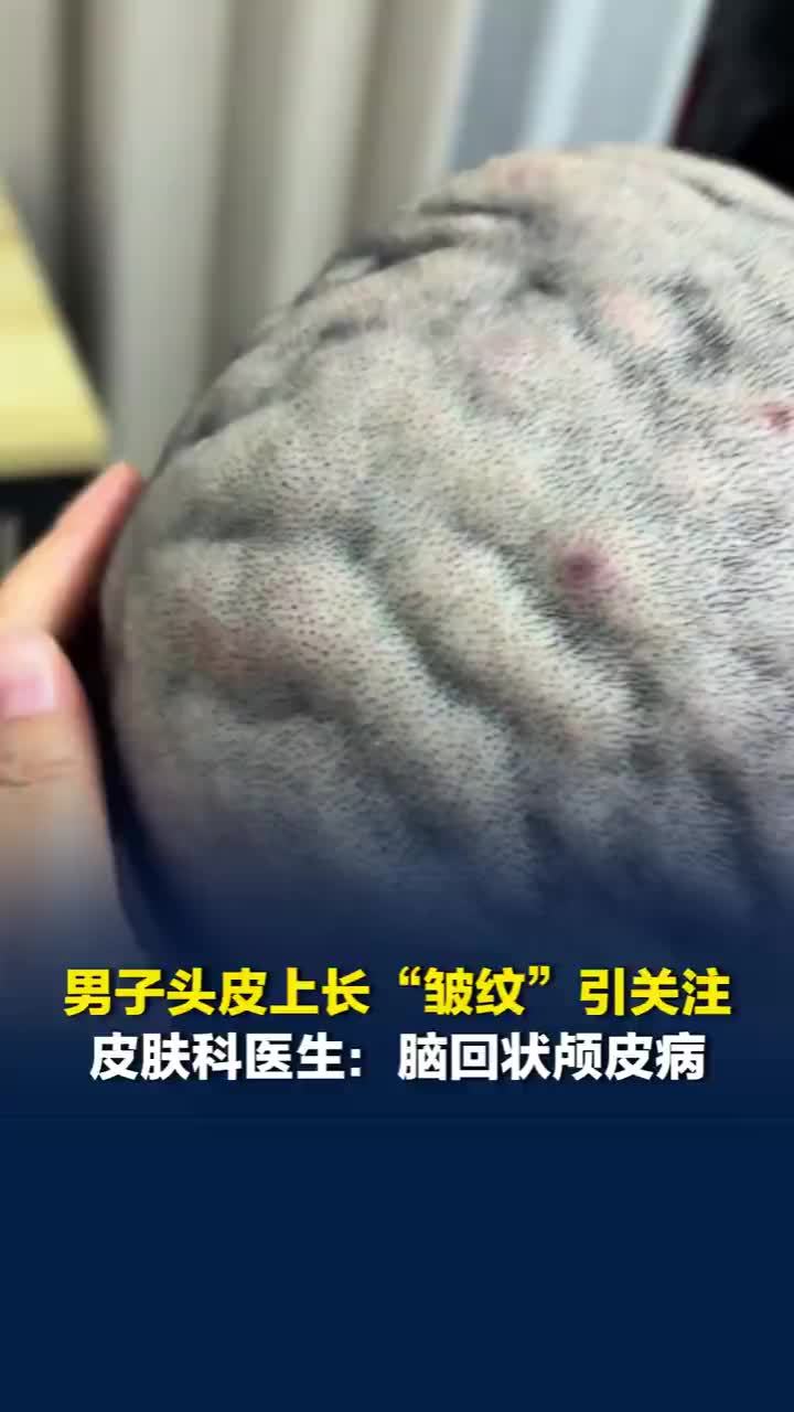 医生谈男子头皮现多条褶皱像脑花：脑回状颅皮病，头皮皮肤过度生长的畸形外观