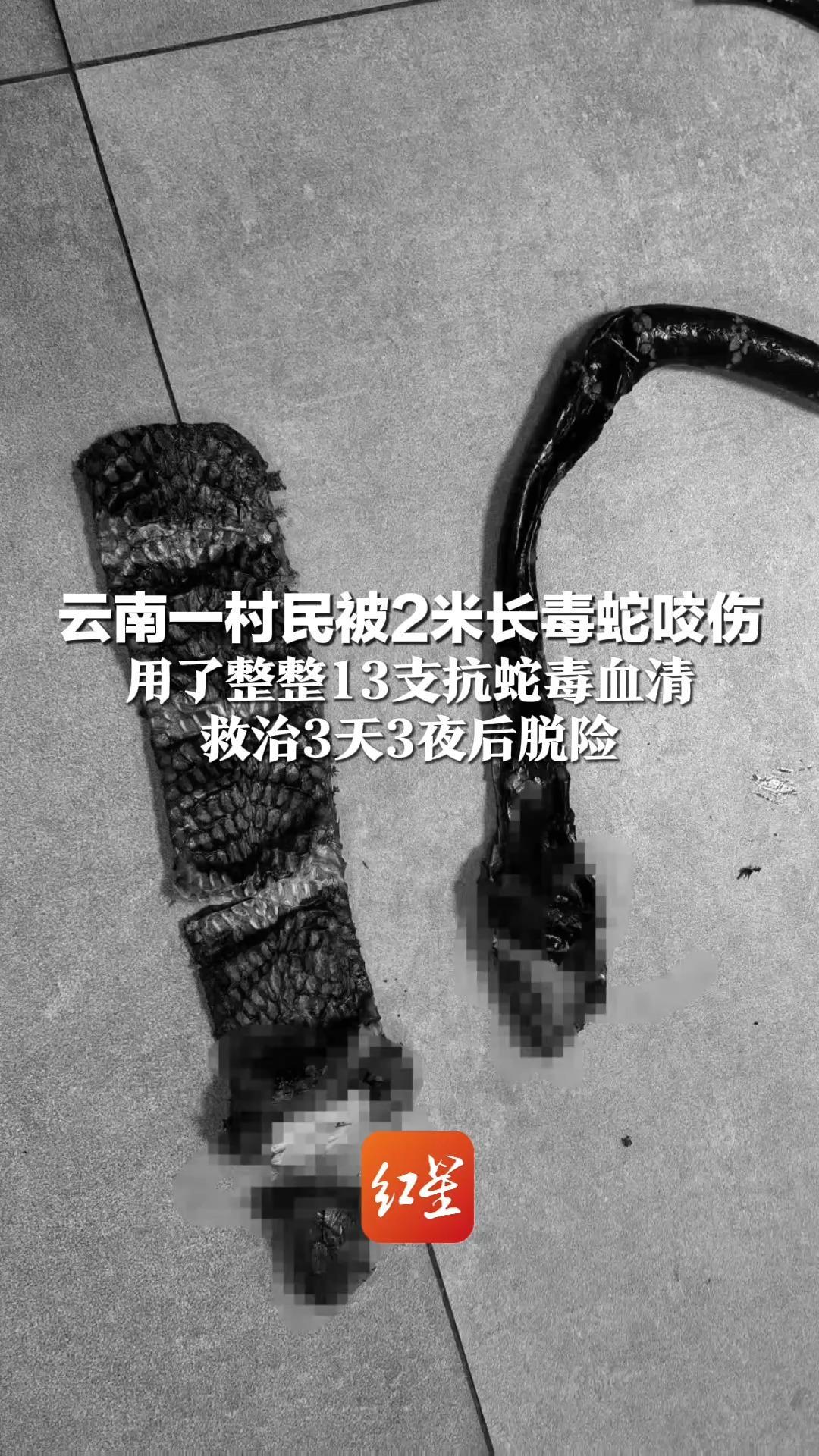 云南一村民被2米长毒蛇咬伤  用了整整13支抗蛇毒血清  救治3天3夜后脱险 经确认为“毒蛇之王”眼镜王蛇