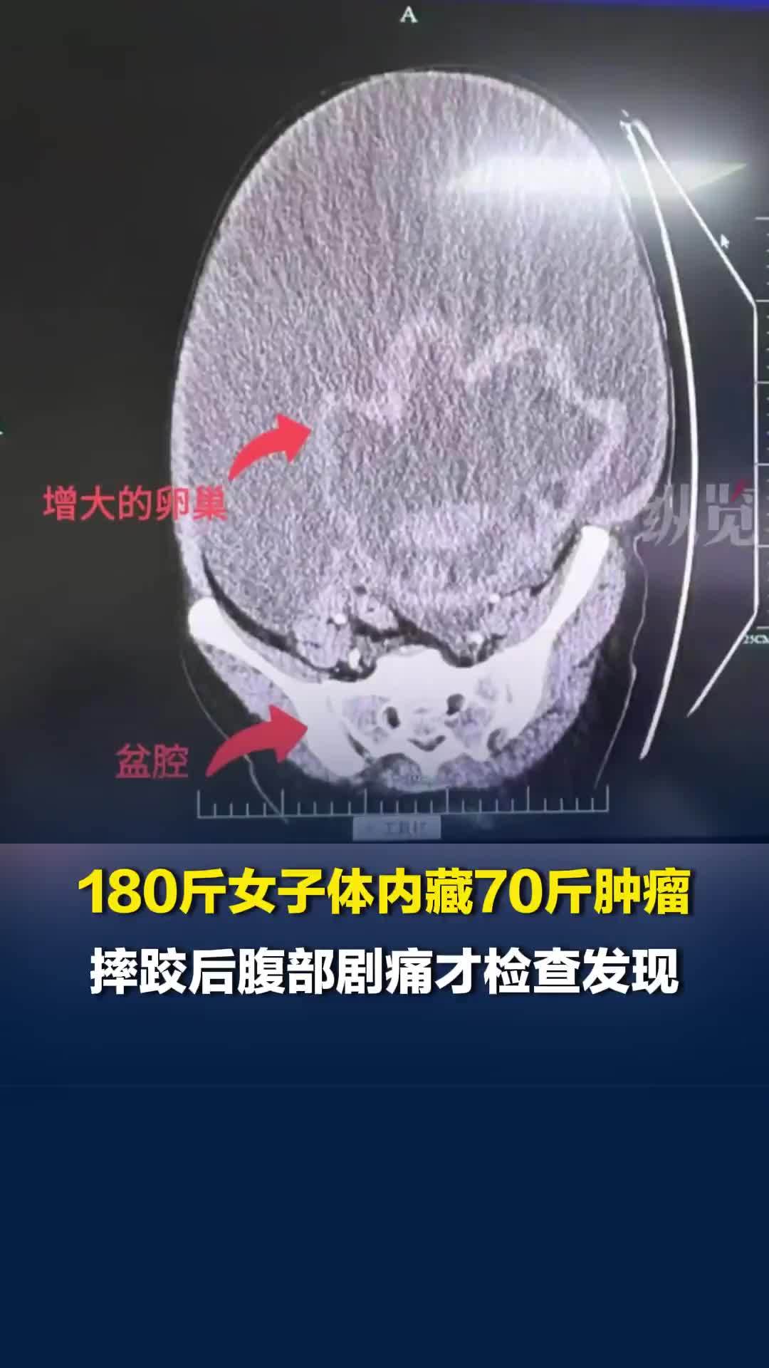 摔跤摔出70斤巨瘤！女子误把肿瘤当“家族遗传胖”，医生：太危险了
