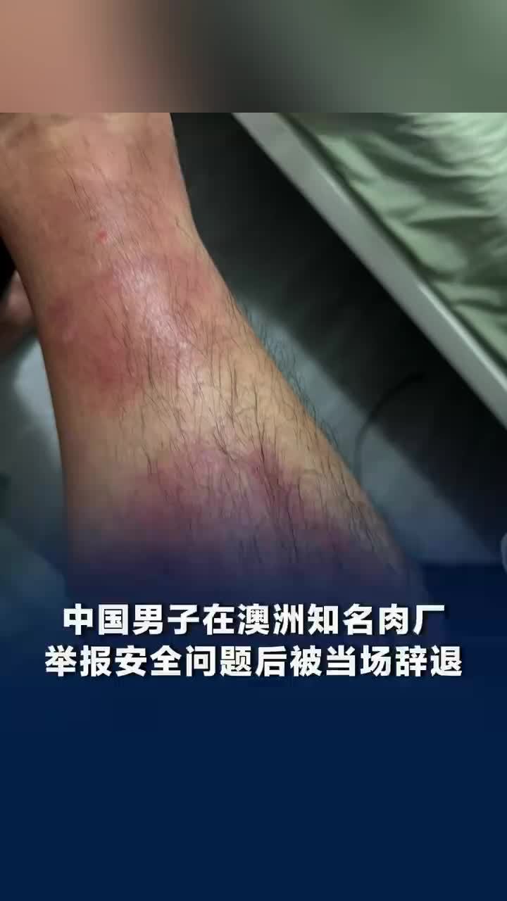 中国男子举报澳洲肉厂安全问题被辞，中国男子澳洲肉厂工作腿部感染红肿