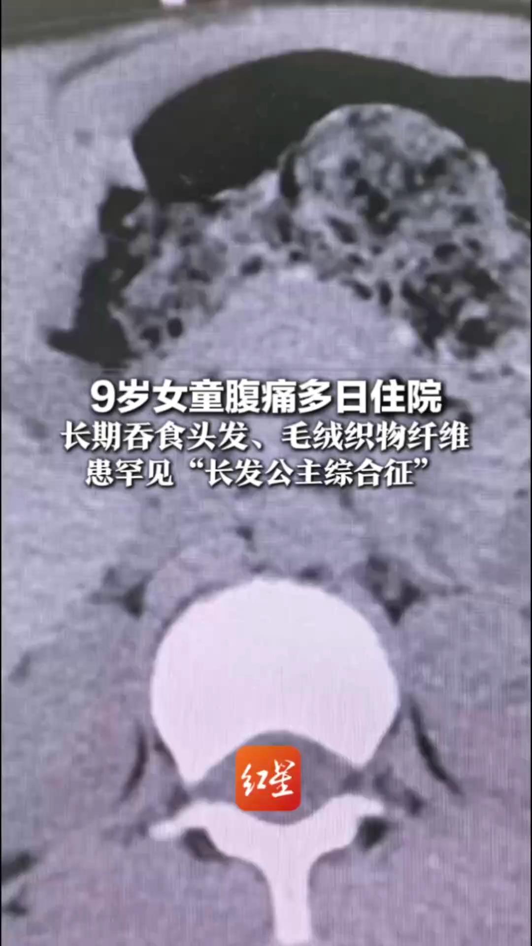 9岁女童腹痛多日住院 长期吞食头发、毛绒织物纤维 患罕见“长发公主综合征” 毛发结石占据胃腔三分之二