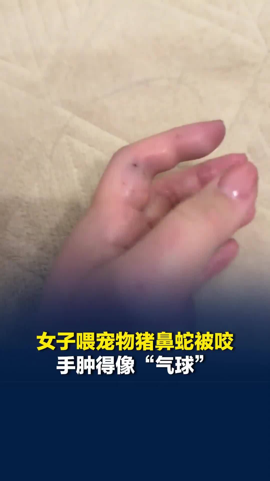 江苏一女子喂宠物猪鼻蛇被咬，手肿得像“气球”，当事人：因手沾鼠尿被误伤