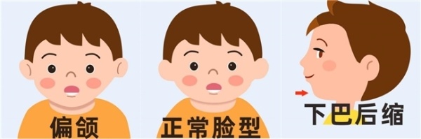 早预防 早干预 少走正畸弯路 惠州口腔医院专家呼吁正畸治疗需把握“黄金期”