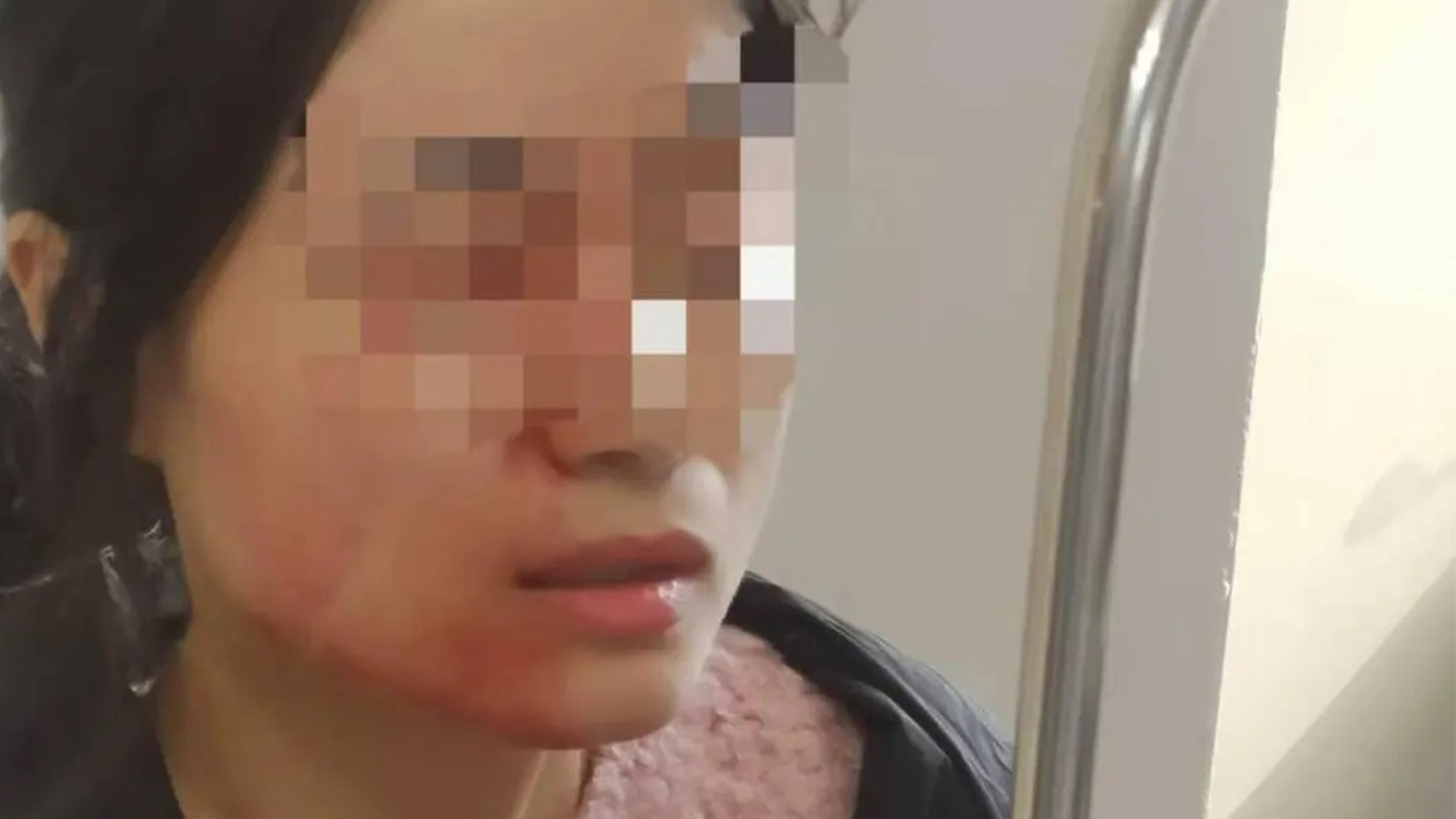 浙江一女教师因劝架被六年级女生用镊子戳伤眼球，经法医鉴定为轻伤二级，警方：构成故意伤害，未满14岁免予行政处罚