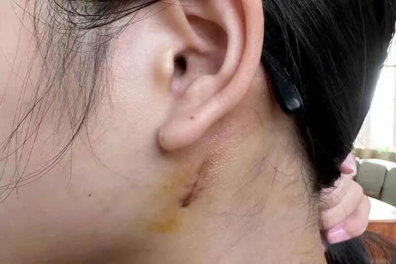 我终于结束了伤口化脓的漫长治疗丨作者供图