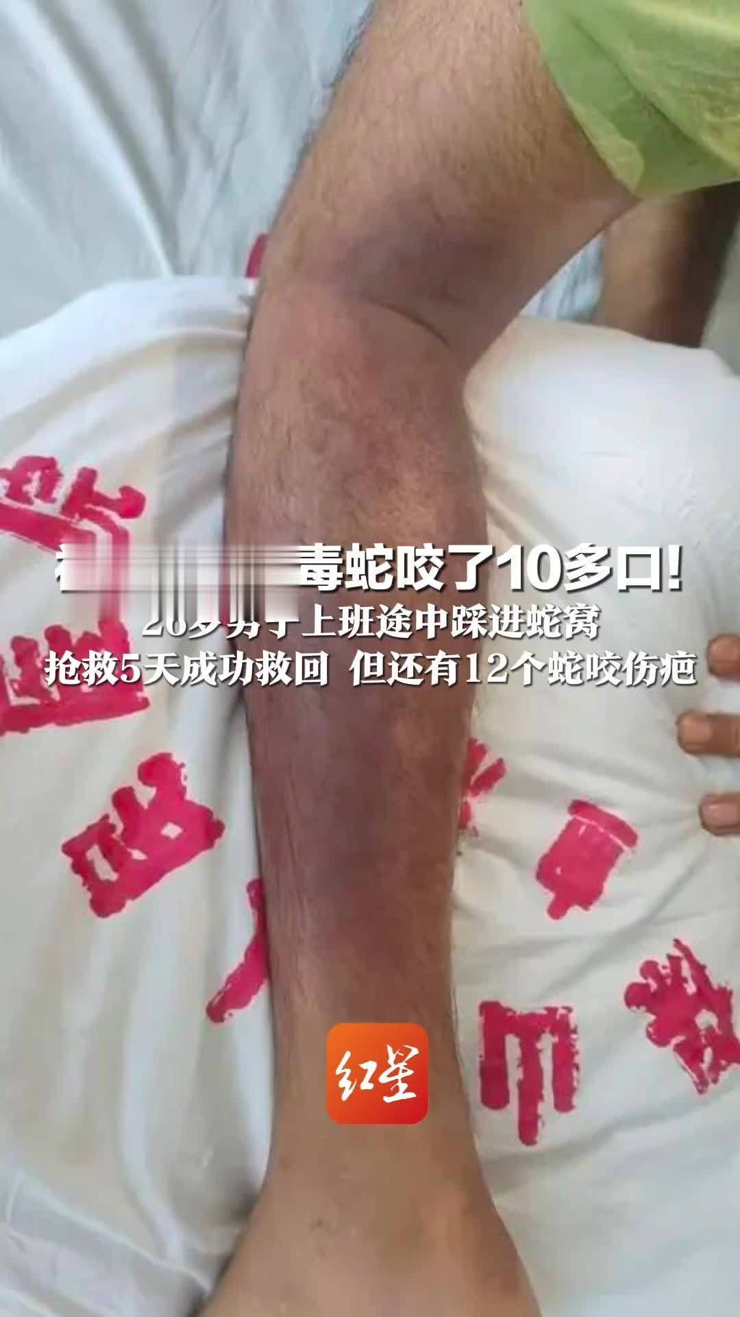 被至少3条毒蛇咬了10多口！26岁男子上班途中踩进蛇窝 胸口剧痛全身酸麻 1小时后彻底休克 抢救5天成功救回 但还有12个蛇咬伤疤