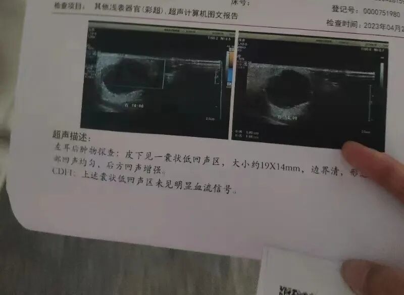 超声显示表皮样性囊肿可能丨作者供图