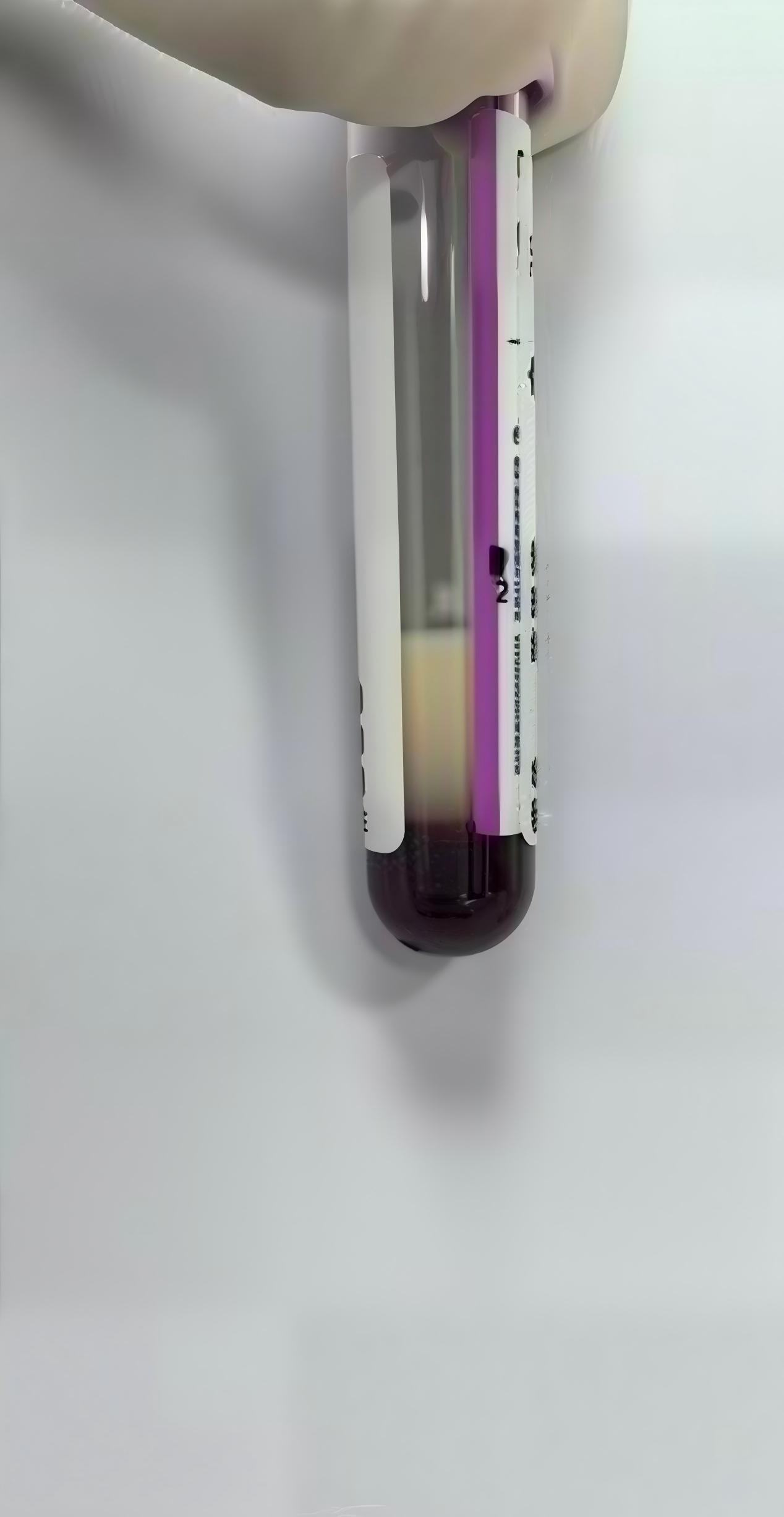 每天三四杯奶茶“续命”，深圳39岁女子血液变成“牛奶色”！龙岗区二院ICU三次血浆置换化险为夷