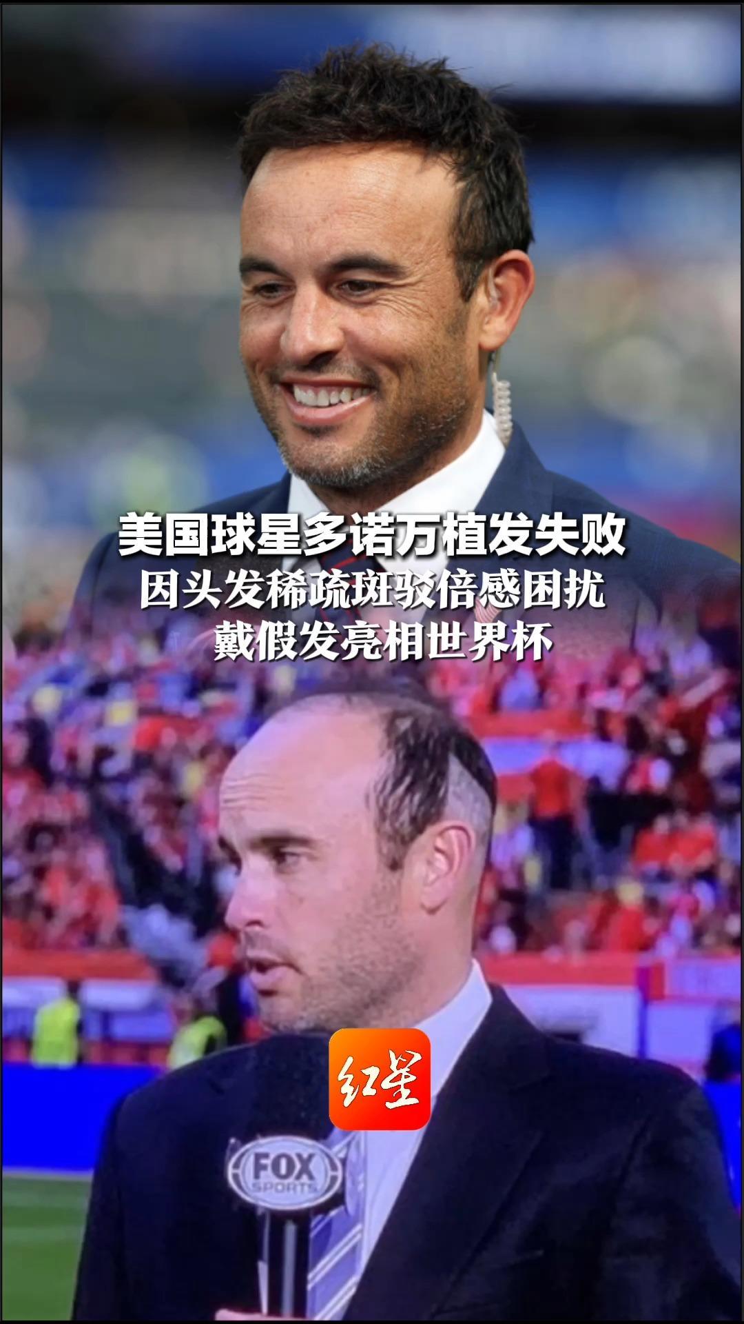 美国球星多诺万植发失败 因头发稀疏斑驳倍感困扰 戴假发亮相世界杯：气场判若两人，自信心爆棚
