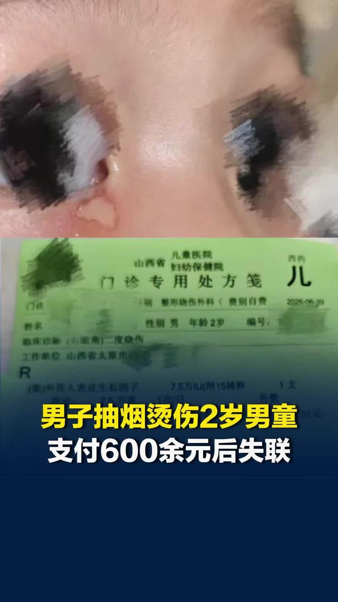 男子抽烟烫伤2岁男童，付600余元后失联，家属：希望赔偿误工费、治疗费等1万元