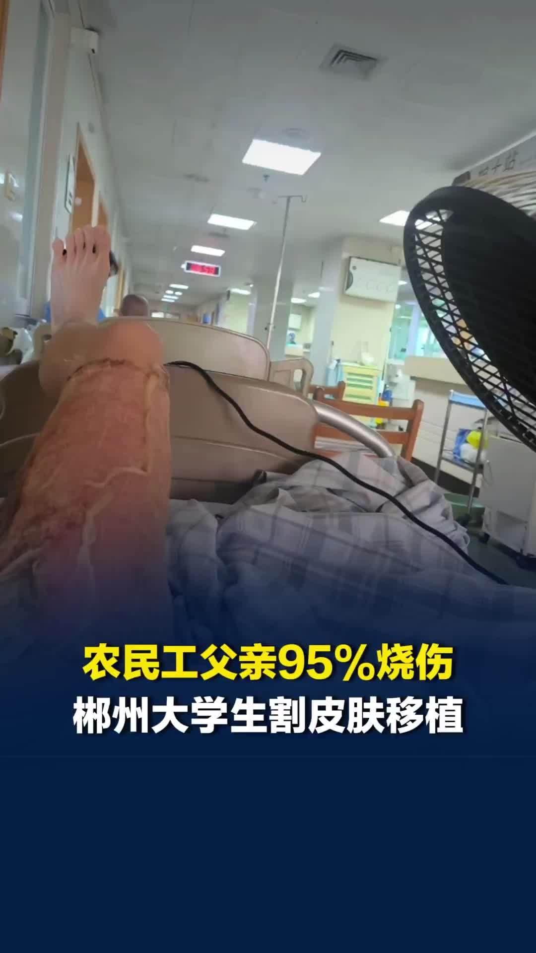 农民工父亲95%烧伤，郴州大学生停学2月照看，割皮肤移植：他辛苦一辈子供我上学