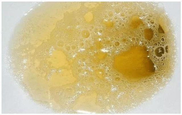 小便出现这种泡沫，肾已损害51%？大夫：3个自测治安在家就能作念