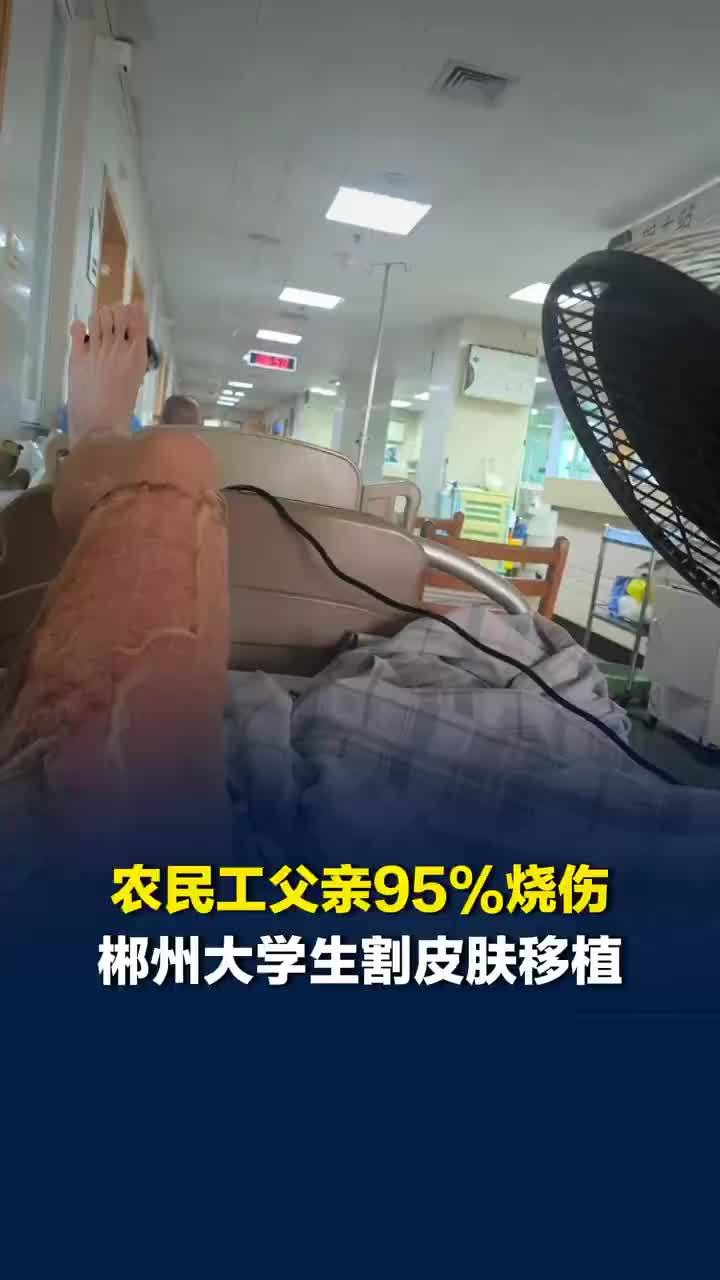 大二儿子割皮救烧伤95%父亲，停学2月割皮救父大学生发声：我想要留住他